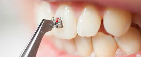 Behandlungsdauer für Zahnspangen - wie lange muss ich sie tragen?
