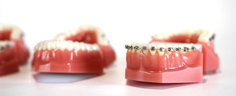 Die verschiedenen Zahnspangen-Bauarten